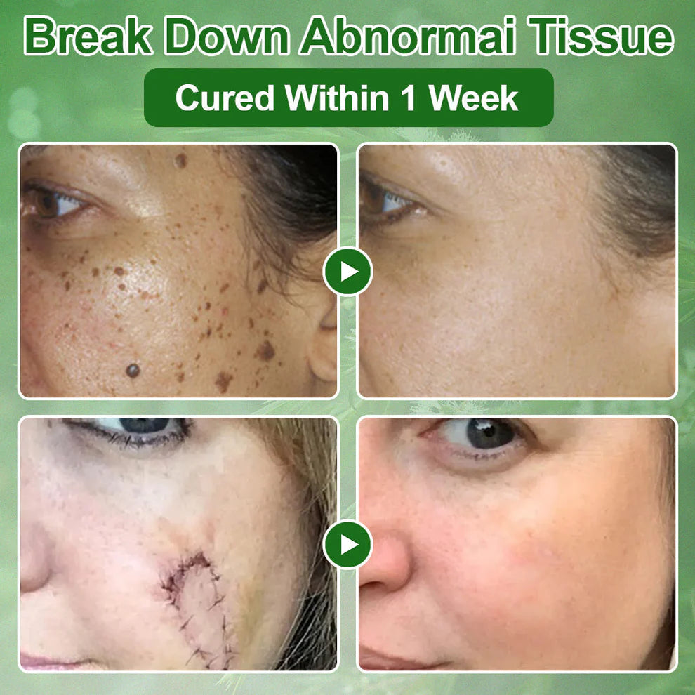 Tea Tree Oil Skin Treatment Cream✅𝐅𝐃𝐀-𝐀𝐏𝐏𝐑𝐎𝐕𝐄𝐃 – Removes Skin Blemishes, Repairs Damaged Skin, Brightens & Anti-Ageing Care