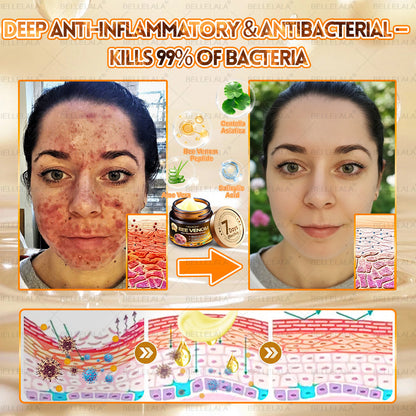 Hot Save 🥇 𝖡𝖾𝖾 𝗏𝖾𝗇𝗈𝗆 𝖲𝗄𝗂𝗇 𝖱𝖾𝗌𝗍𝗈𝗋𝖺𝗍𝗂𝗈𝗇 𝖢𝗋𝖾𝖺𝗆