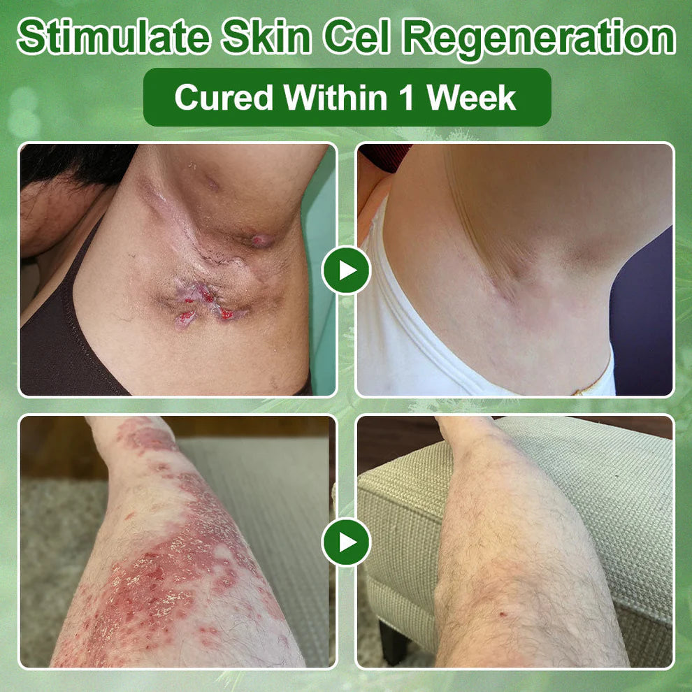 Tea Tree Oil Skin Treatment Cream✅𝐅𝐃𝐀-𝐀𝐏𝐏𝐑𝐎𝐕𝐄𝐃 – Removes Skin Blemishes, Repairs Damaged Skin, Brightens & Anti-Ageing Care